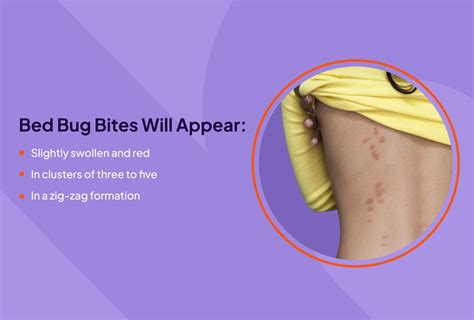 Bed Bug Bite: Appearance, Symptoms, Treatment