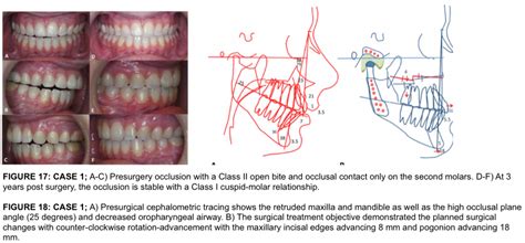 Total Temporomandibular Joint (TMJ) Replacement - Larry M. Wolford, DMD