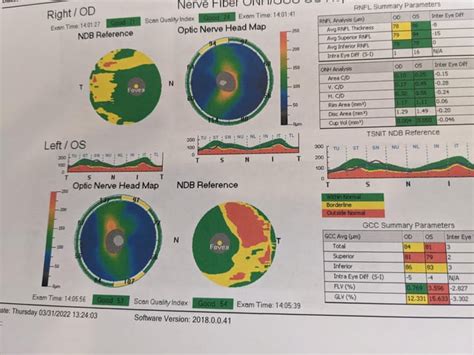 Help - Glaucoma Suspect (OCT Scans Attached) : r/optometry