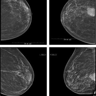 Follow‐up bilateral breast ultrasound images, 11 weeks from initial... | Download Scientific Diagram