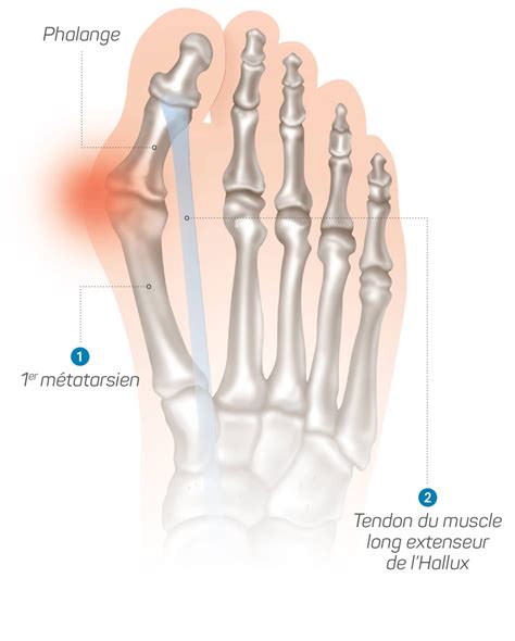 Hallux valgus - Causes et traitements de l'oignon au pied - Orliman