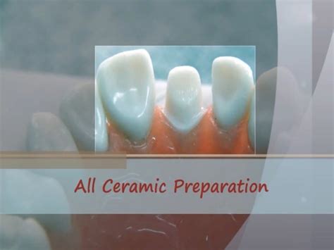 All ceramic crown preparation seminar