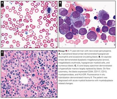 A 71-year-old man with new-onset pancytopenia. A, A peripheral blood smear demonstrated ...