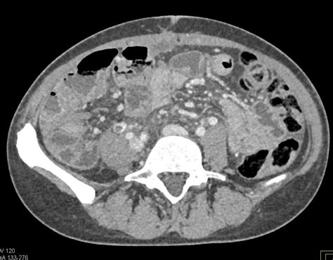 Gonadal Vein Thrombosis on the Right - Vascular Case Studies - CTisus ...