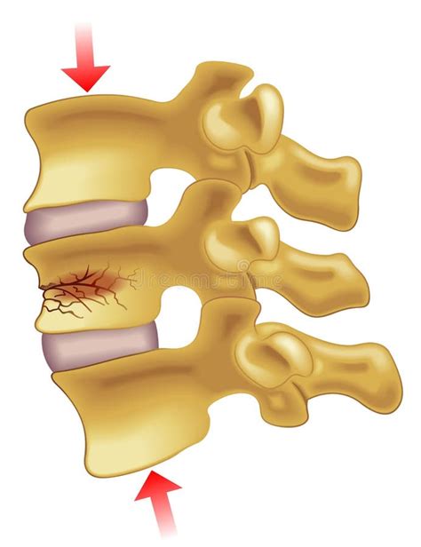 Osteoporosis stock vector. Illustration of anatomy, hormones - 25447568