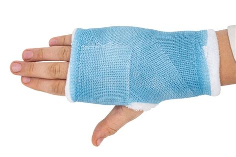 Broken hand in cast stock photo. Image of accident, isolated - 123137612