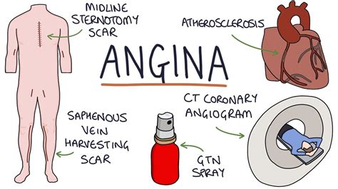 Understanding Angina: Visual Explanation for Students - YouTube