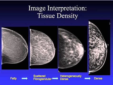 Breast Radiology Center Mammography Breast Mri - vrogue.co