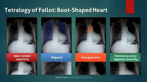 Tetralogy Of Fallot Chest X Ray