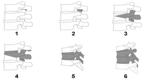 Pedicle Subtraction Osteotomy for Treatment of Sagittal Plane Deformity - cns.org