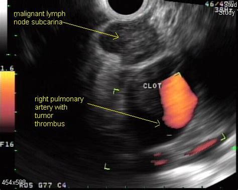 Non small cell lung cancer ultrasound - wikidoc