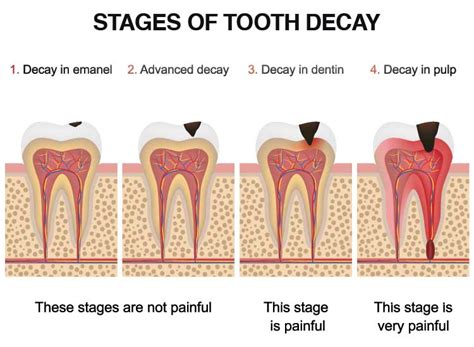 What Is An Abscessed Tooth And How To Treat It?