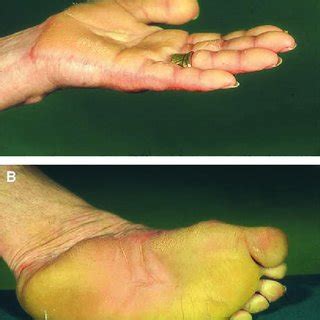 Marked thickening and subungual hyperkeratosis in a patient with PC-1 ...