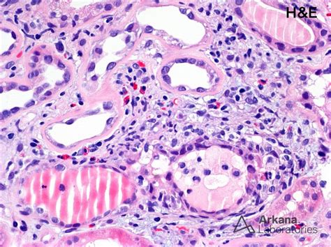 Eosinophil-Rich Inflammation in Diabetic Glomerulopathy | Teaching Points