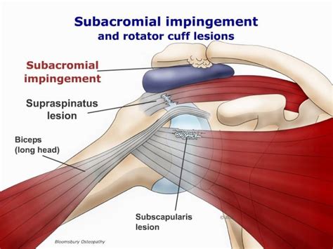 Impingement of the shoulder SHOP02 - Bloomsbury Health Centre