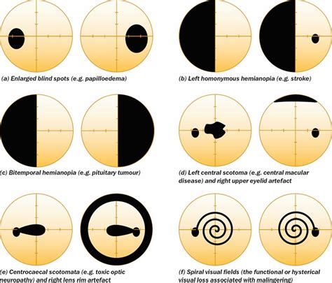 Visual field test, visual field test results interpretation