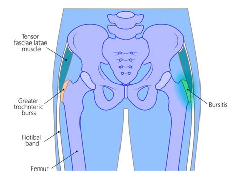 Trochanteric Bursitis | Greater Trochanteric Pain Syndrome | GTPS ...