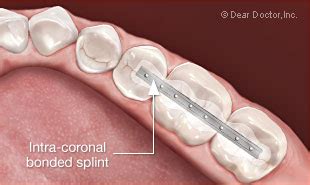 Dental Splinting Can Save Loose Teeth | Periodontal Associates of Memphis