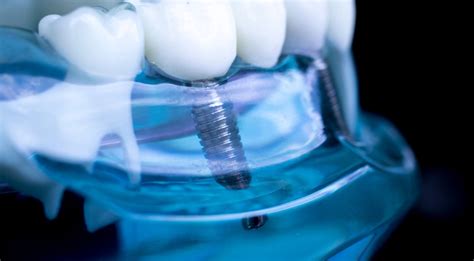 What are the alternatives to dental implants - FindGlob