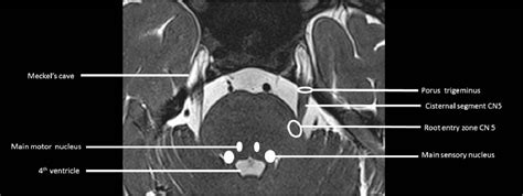 Trigeminal Ganglion Mri