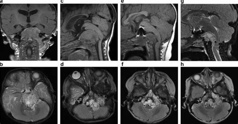 a–d Initial diagnostic imaging demonstrating a heterogenous mass ...
