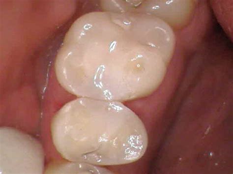 Amalgam Filling Replacement | London Holistic Dental