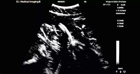 Amazing footage of pregnant shark's ultrasound scan - with 20 babies shown wriggling around ...