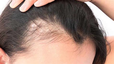 Treating Permanent and Temporary Traction Alopecia - Dot Com Women