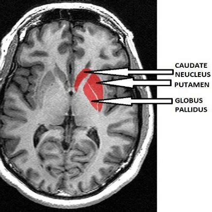 MRI brain scan showing normal anatomy of the striatum. | Download Scientific Diagram