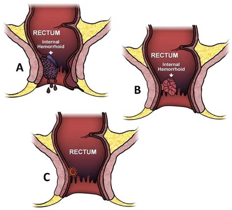 Hemorrhoids Bleeding