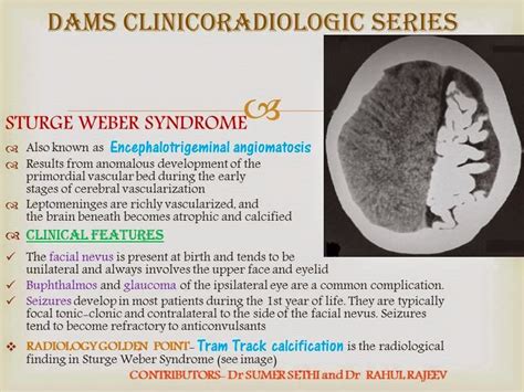 Sumer's Radiology Blog: Sturge Weber Syndrome: Clinicoradiological ...