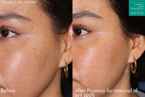 PicoWay Tattoo Removal San Diego, CA | Cosmetic Laser Dermatology