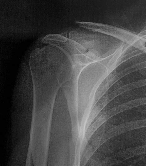 Free Stock Photo of Bone fracture of the collarbone | Download Free ...