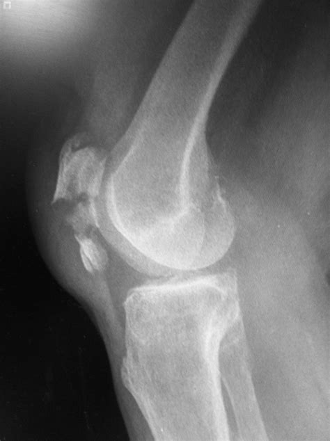 Patella fracture (lateral X-ray) | Patella fracture, Medical knowledge ...