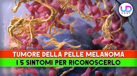 Skin Cancer, Melanoma: The 5 Symptoms to Recognize It! - Breaking Latest News