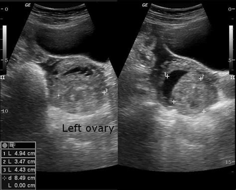 Corpus Luteum Ultrasound