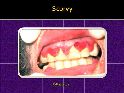 PPT - Scurvy: Causes, Symptoms, Daignosis, Prevention and Treatment PowerPoint Presentation - ID ...