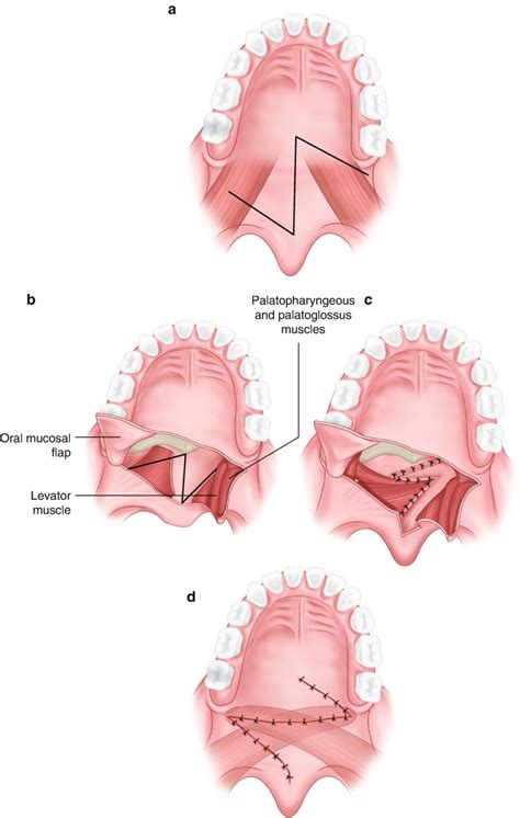 Velopharyngeal Insufficiency | Ento Key