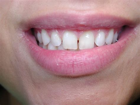 Dental Bonding: A Relatively Inexpensive Way to Close Gaps Between Front Teeth – Dr. Mark ...