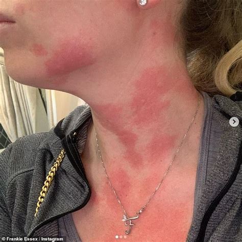 Frankie Essex reveals her horrific 'hot and itchy' neck rash following dog walk | Daily Mail Online