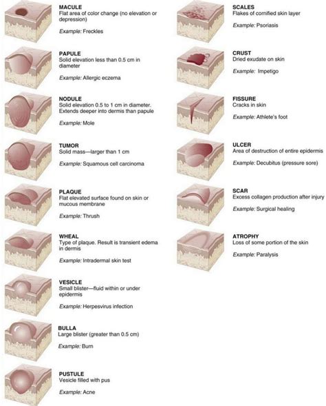 Types of Skin Lesions : r/coolguides