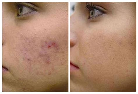 The gallery for --> Tretinoin Cream Before And After Acne