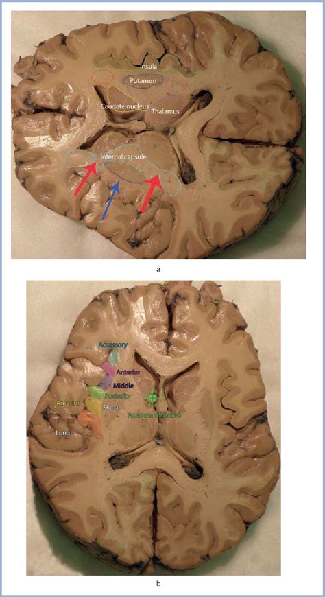 Figure 1 from [Surgical anatomy of the insular cortex]. - Semantic Scholar