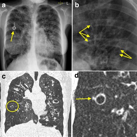 Bronchiectasis - CXR and CT - Radiology at St. Vincent's University Hospital