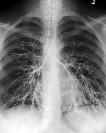 Bronchogram | Radiology Case | Radiopaedia.org