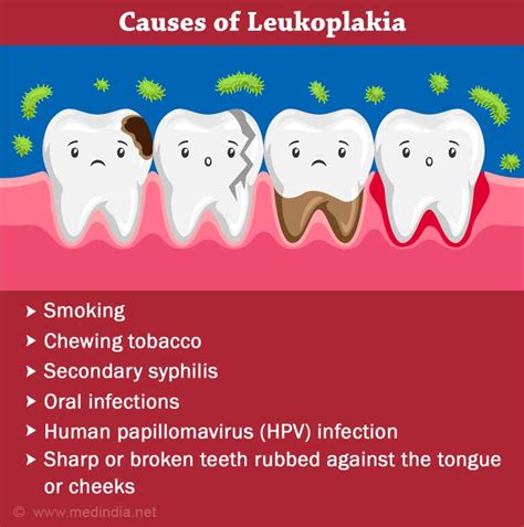 Leukoplakia - An Overview of Causes, Symptoms & Treatment