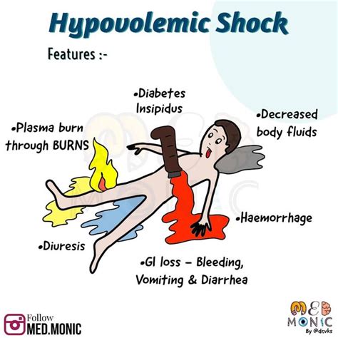 Hypovolemic Shock Features: Medical Mnemonics