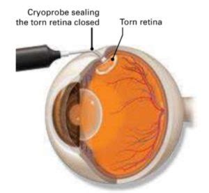 Retinal Tear - Macula Retina Vitreous Center