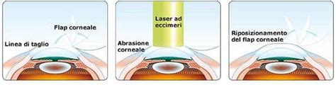 LASIK for Hypermetropia Hypermetropia - Laser and Treatments - Micro ...