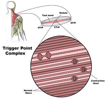 Trigger Points 101: Symptoms, Causes, & Treatment [VIDEO]